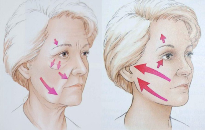 Phẫu thuật căng da mặt duy trì được bao lâu - Thẩm mỹ Á Đông quận 3