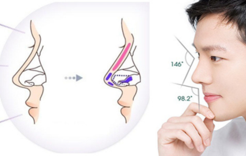 Nâng mũi nam: như thế nào là tự nhiên - Thẩm mỹ viện Á Đông