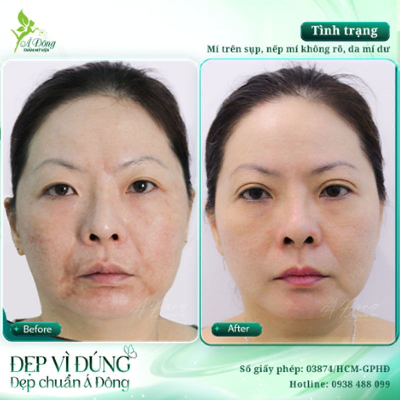 Nạo silicon vùng cằm thẳm mỹ hỏng - Thẩm mỹ viện Á Đông
