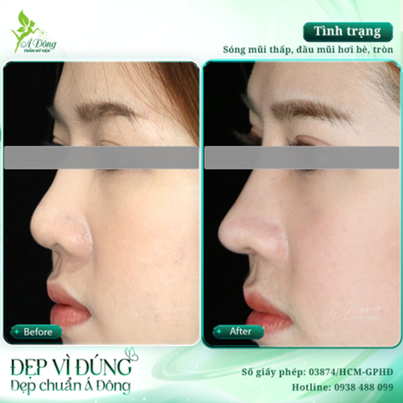 Trường hợp nên nạo Silicon chỉnh sửa mũi hỏng - Thẩm mỹ viện Á Đông