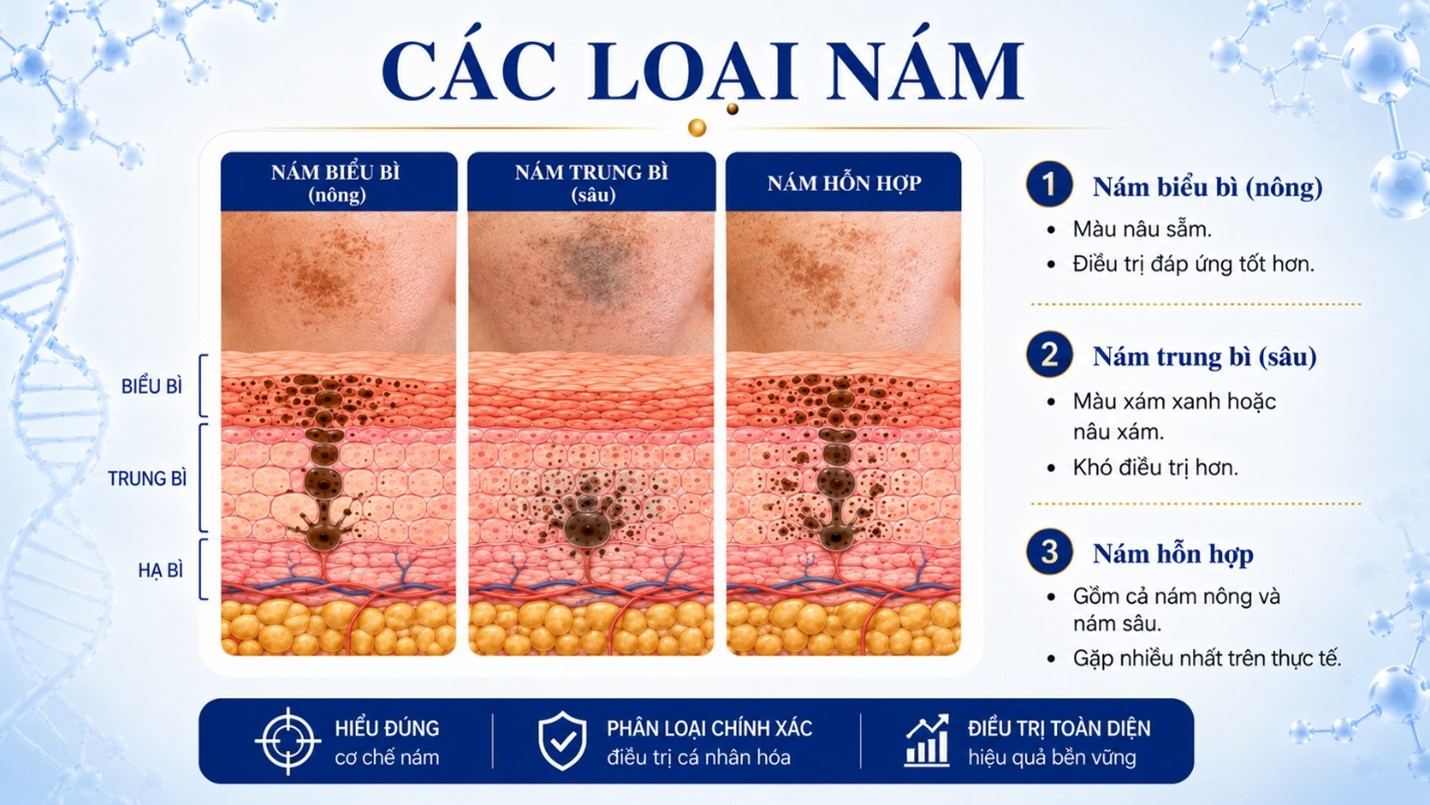 Các loại nám da phổ biến gồm nám mảng, nám chân sâu và nám hỗn hợp