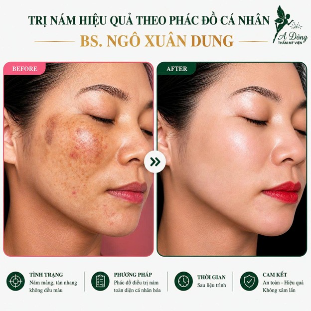 Hiệu quả điều trị nám với hình ảnh khách hàng trước và sau thực hiện