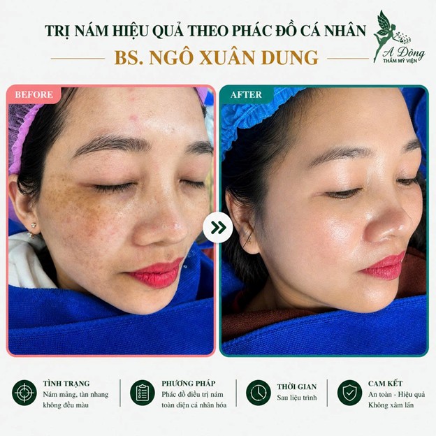 Hình ảnh khách hàng trước và sau điều trị nám tại Thẩm mỹ viện Á Đông