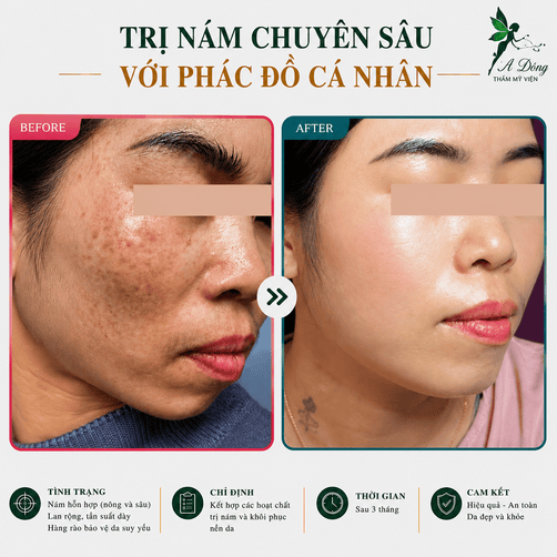 Kết quả trước và sau điều trị nám chuyên sâu với phác đồ cá nhân hóa