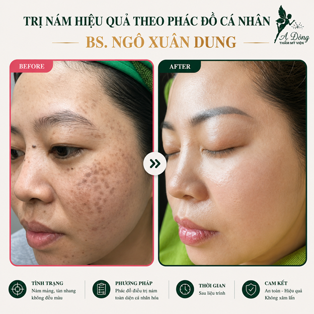 Khách hàng trước sau điều trị nám