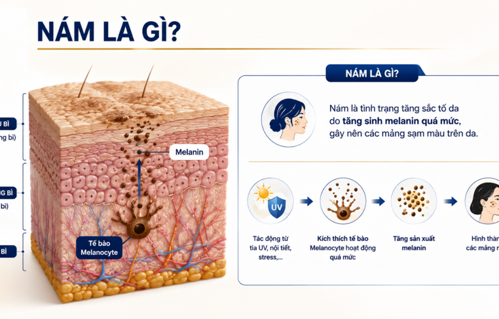 Nám da là gì Nguyên nhân và dấu hiệu nhận biết nám da