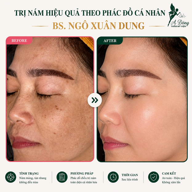 Trước và sau điều trị nám