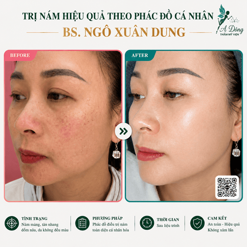 Hình ảnh khách hàng trị nám