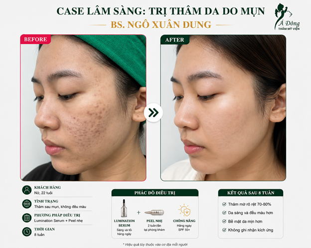 case lâm sàn trị thâm da