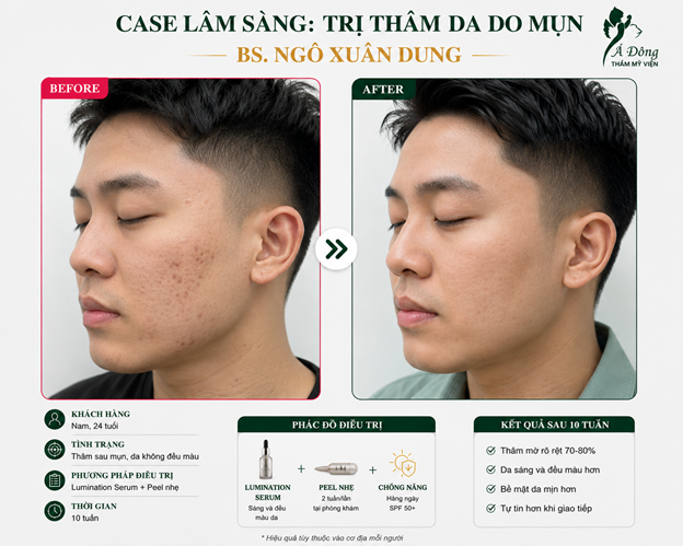 hình ảnh trị thâm da do mụn