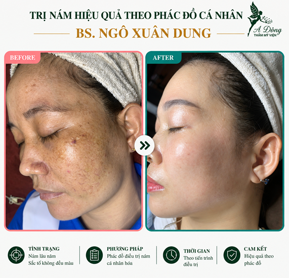 truoc-sau-tri-nam truoc-sau-tri-nam