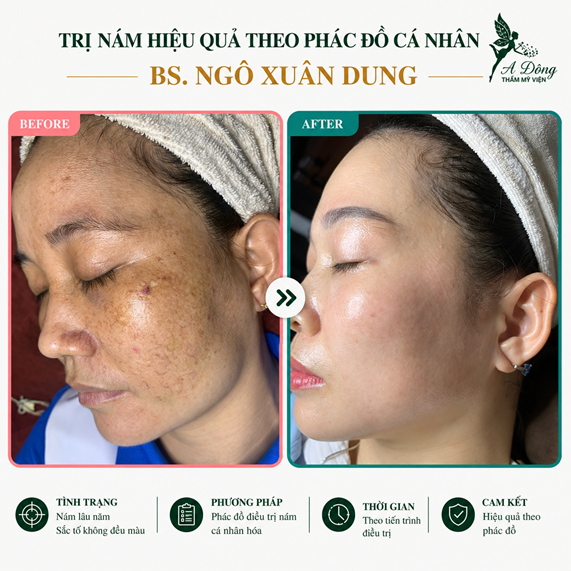 truoc-sau-tri-nam truoc-sau-tri-nam